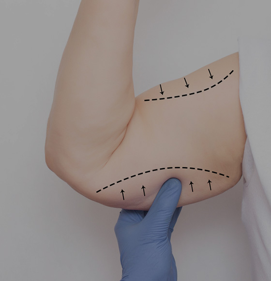 Brachioplasty (Arm Lift)