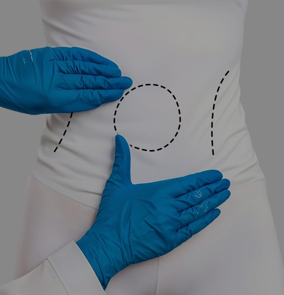 Tummy Tuck (Abdominoplasty)