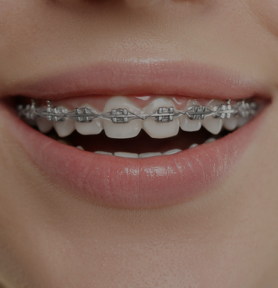 Braces