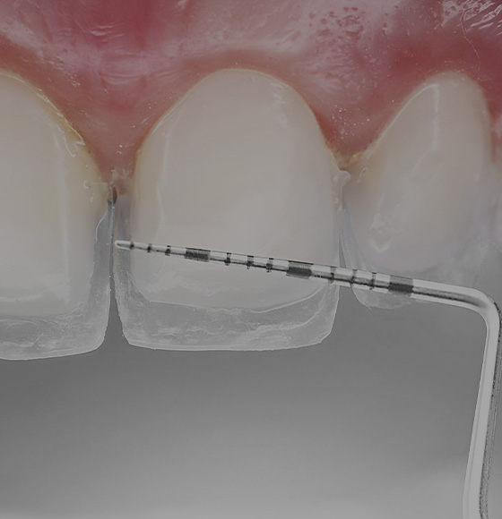 Composite Restorations