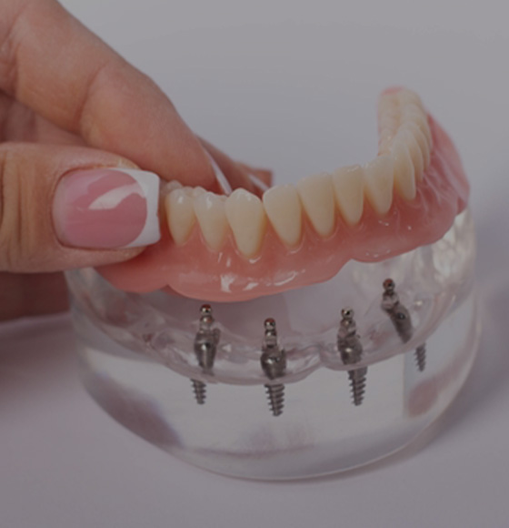 Dental Implants