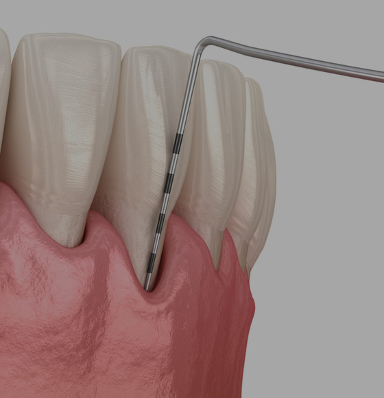 Laser Gingival Depigmentation