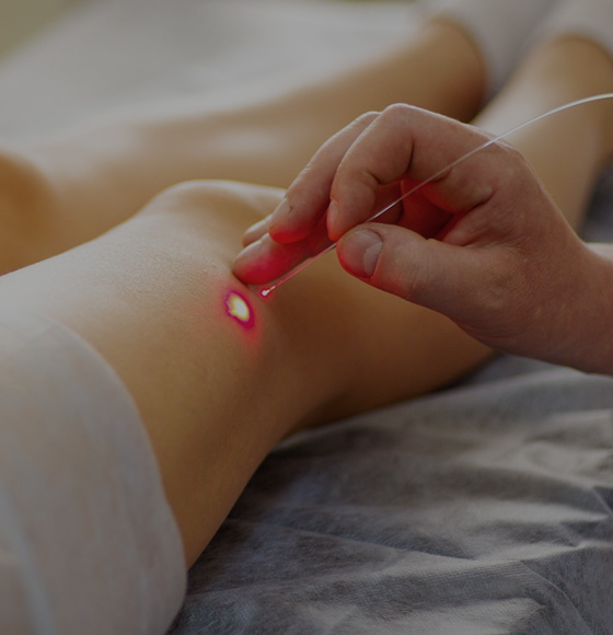 Laser Treatment for Spider Veins & Warts